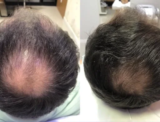 Antes e depois da terapia capilar de um paciente da Homenz