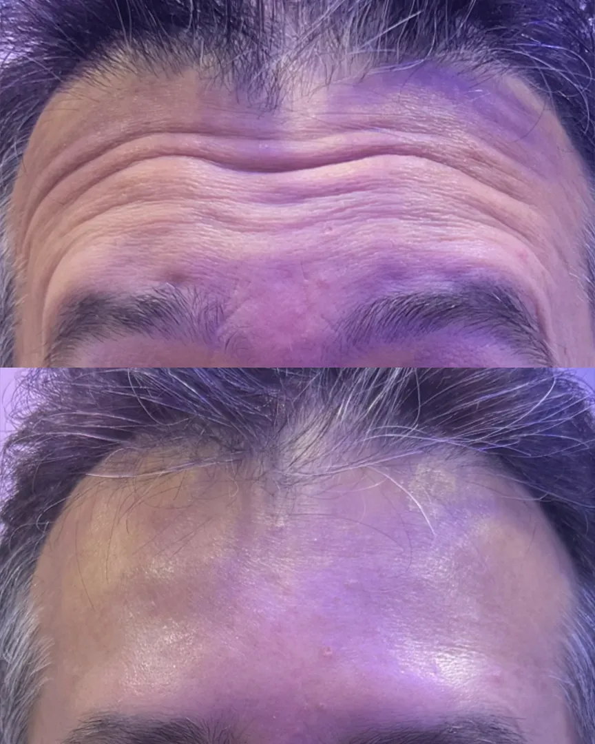 Antes e depois da estética facial: linhas da testa suavizadas