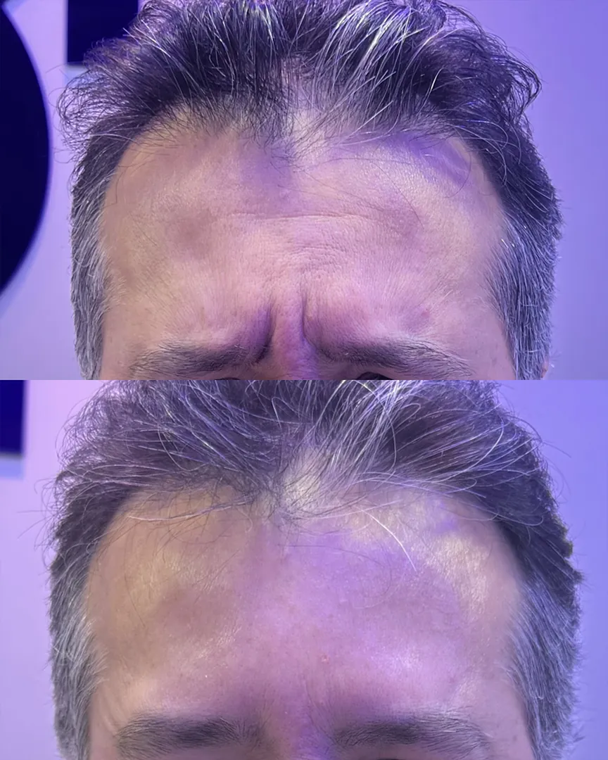 Antes e depois da estética facial: marcas entre as sobrancelhas suavizadas