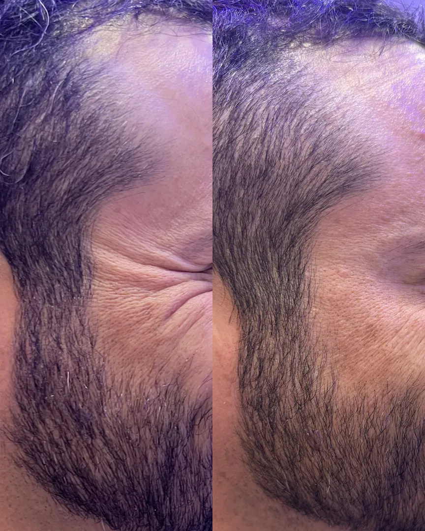 Antes e depois da estética facial: linhas ao redor dos olhos suavizadas
