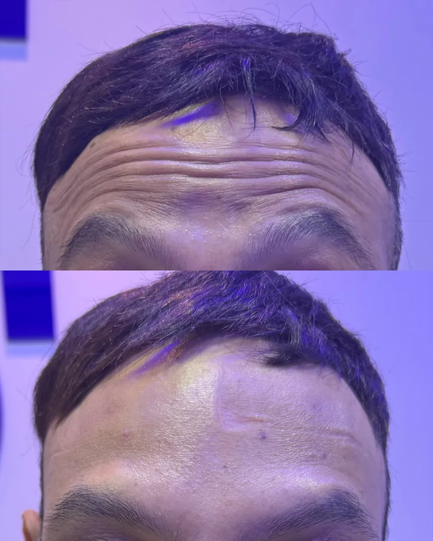 Antes e depois da estética facial: testa com rugas suavizadas