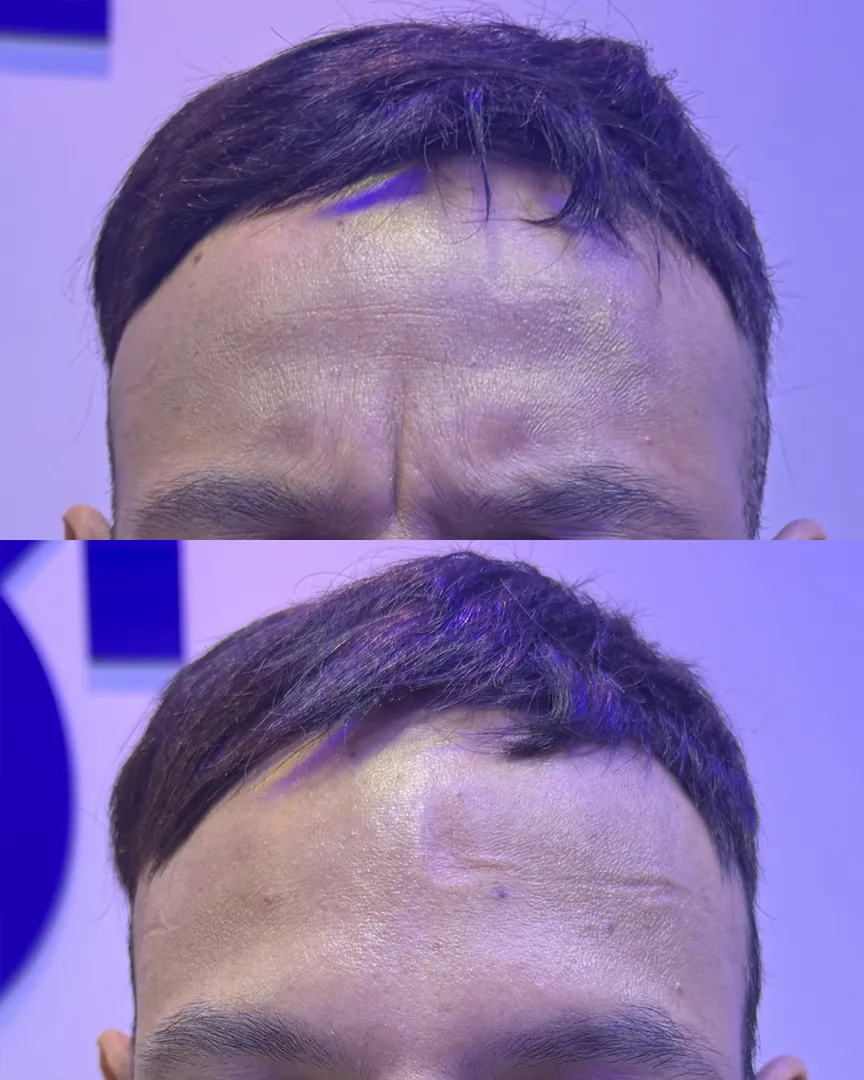 Antes e depois da estética facial: expressão menos tensa