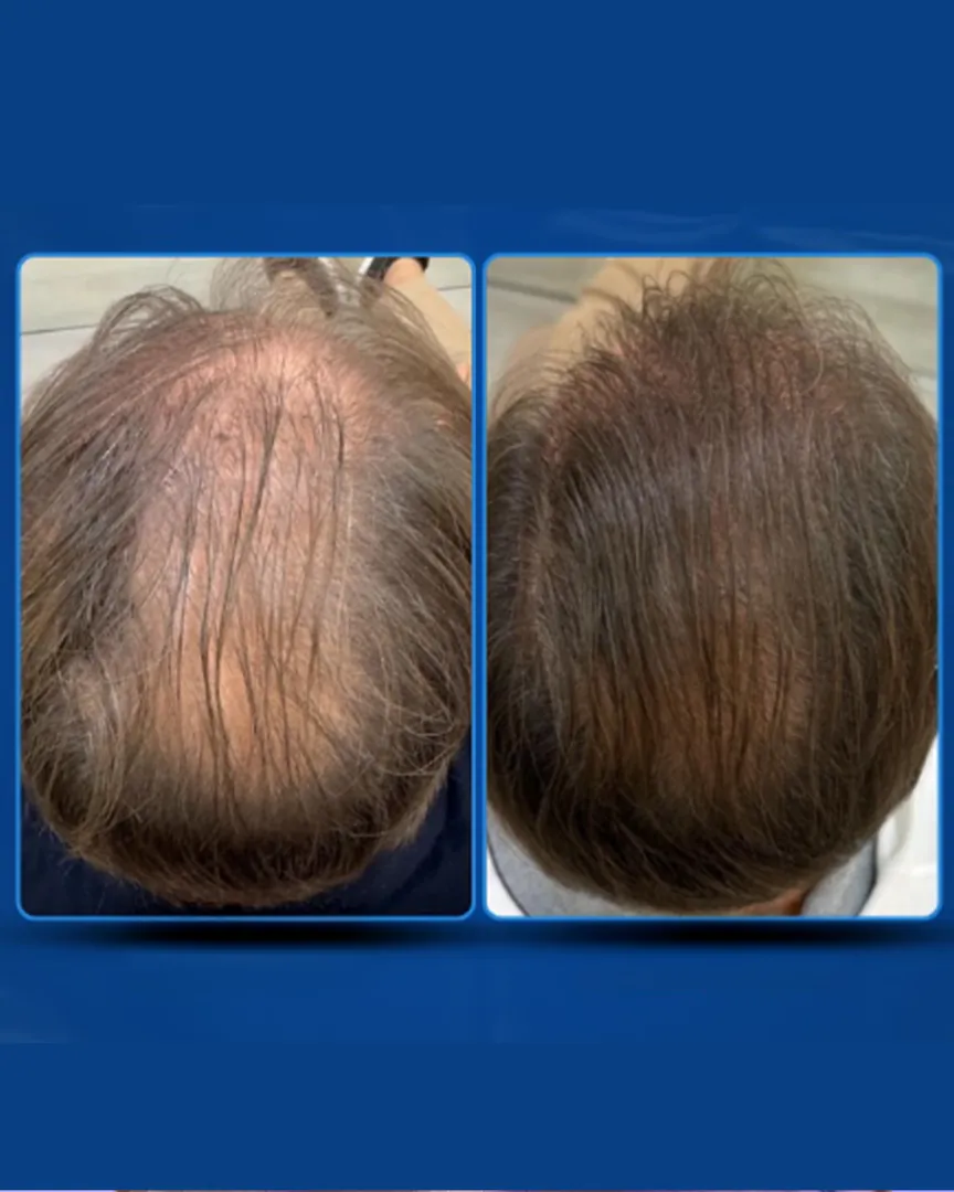 Antes e depois da terapia capilar: coroa com mais volume