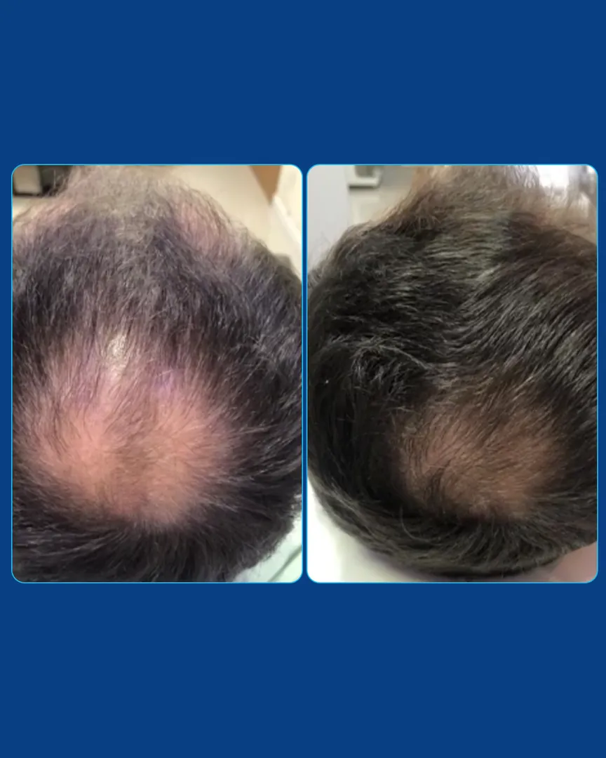 Antes e depois da terapia capilar: falha no topo da cabeça preenchida