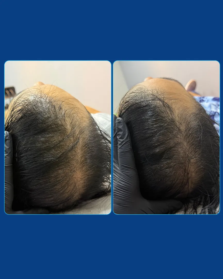 Antes e depois da terapia capilar: fios mais densos